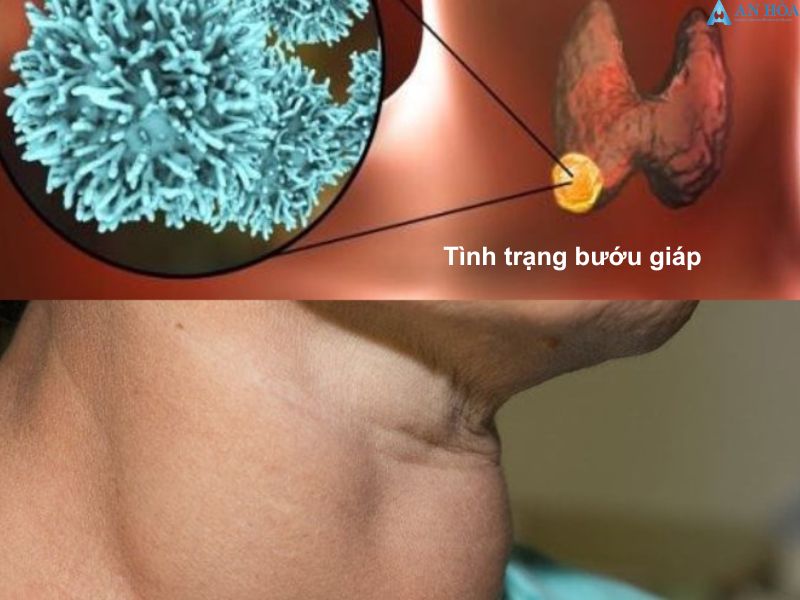 Bệnh về tuyến giáp