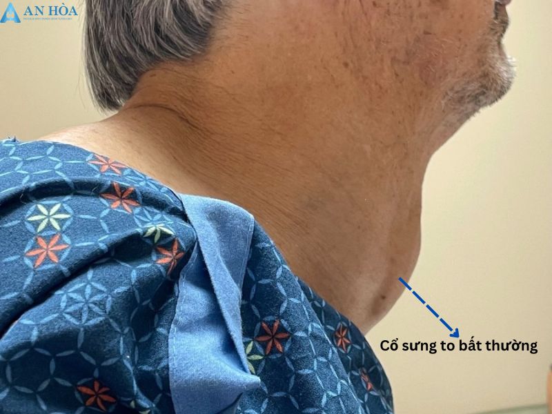 Cách phát hiện bệnh tuyến giáp