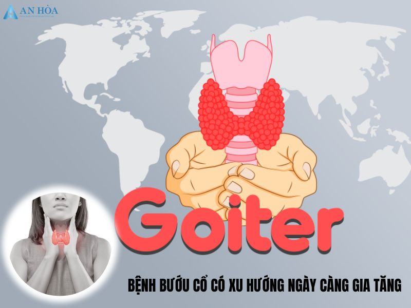 Bướu cổ lan tỏa