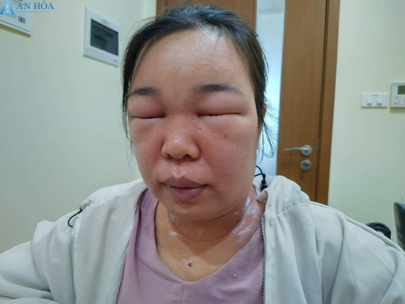 Dấu hiệu tuyến giáp có bệnh