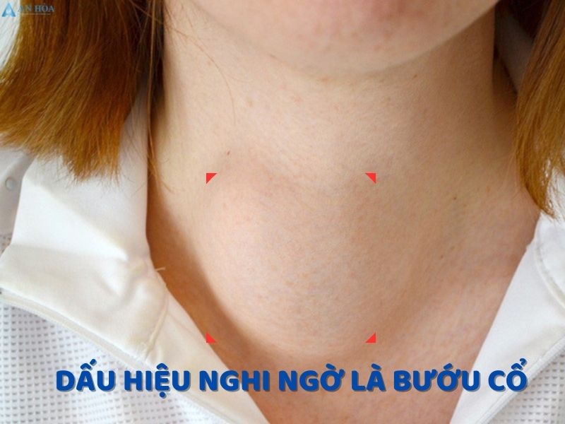 Điều trị bệnh bướu cổ