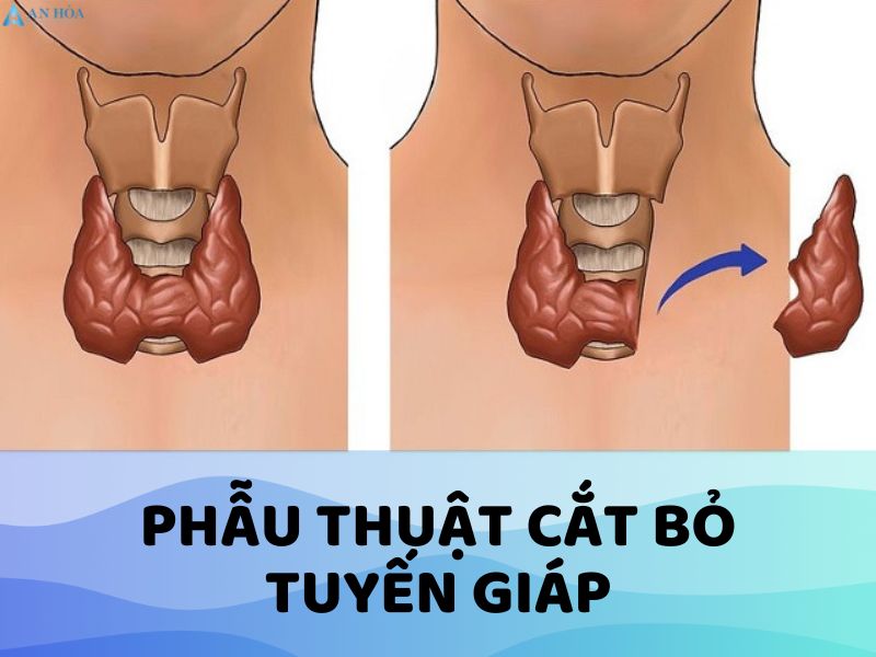 Điều trị bệnh bướu cổ