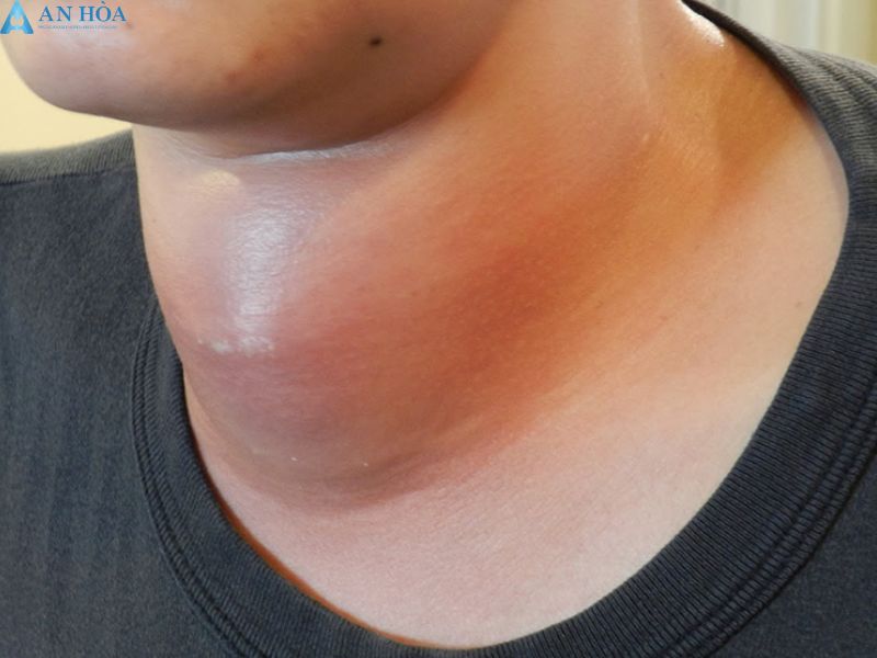 Điều trị viêm giáp