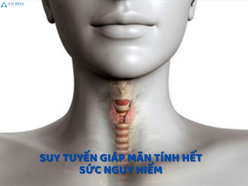 Suy giáp mãn tính