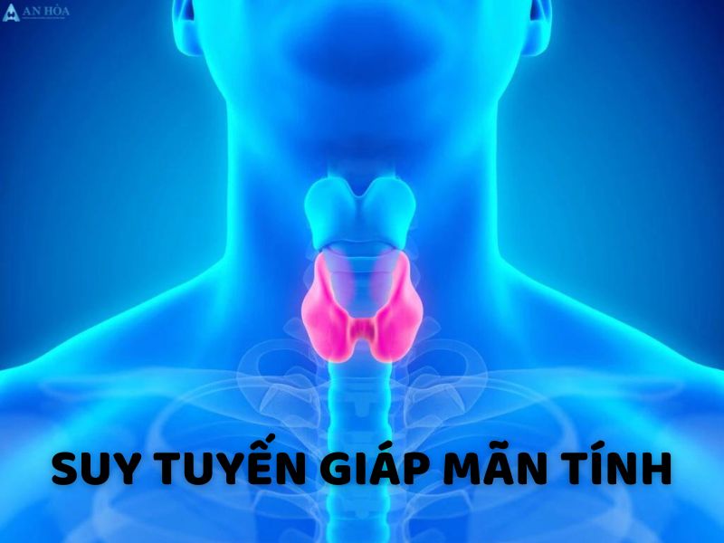 Suy giáp mãn tính