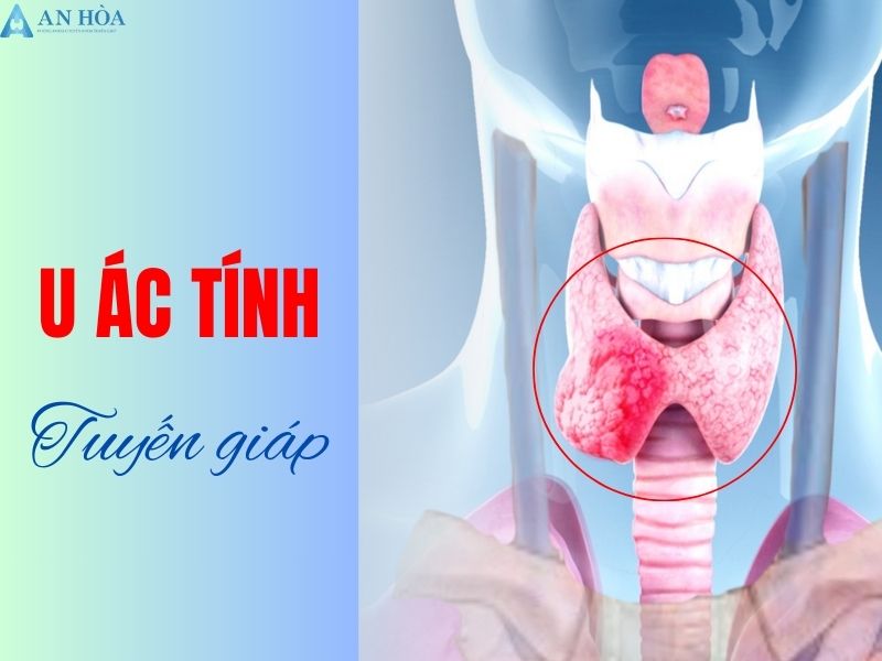 U ác tuyến giáp có chữa được không