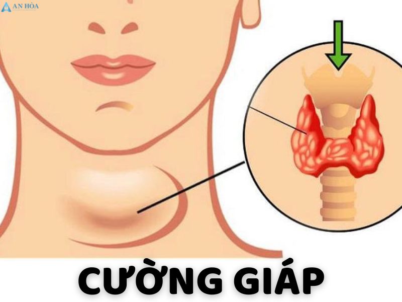 Bị cường tuyến giáp