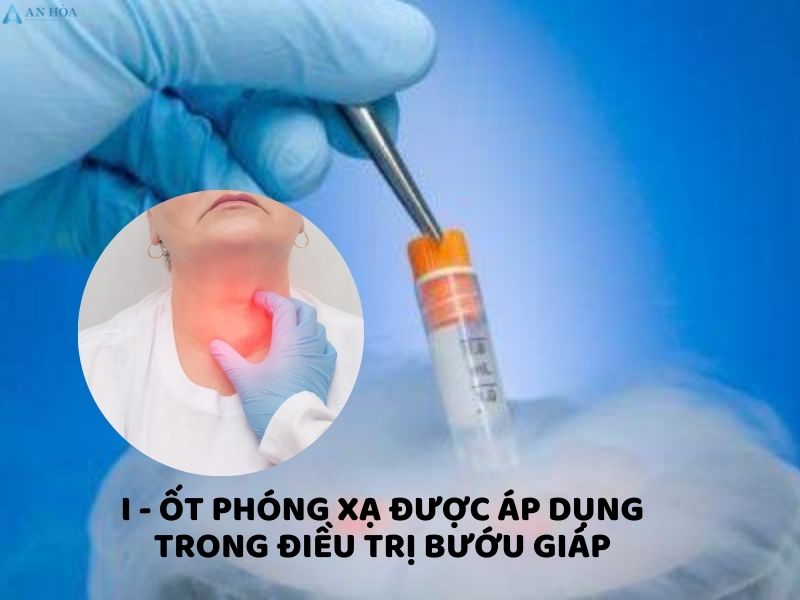 Bướu giáp độ 2