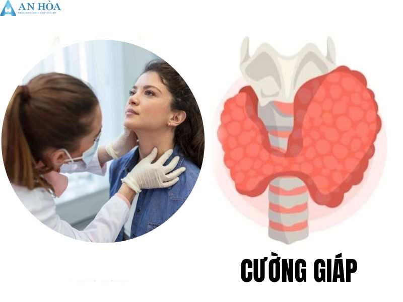 Cách chữa cường giáp