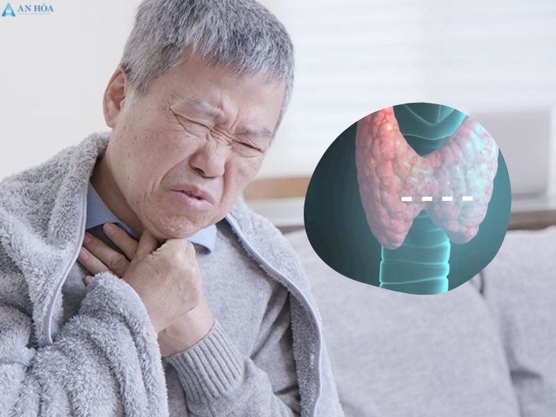 Điều trị bướu cổ