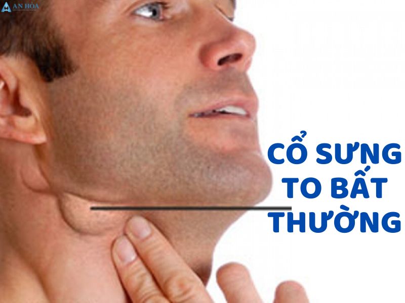 Điều trị bướu cổ