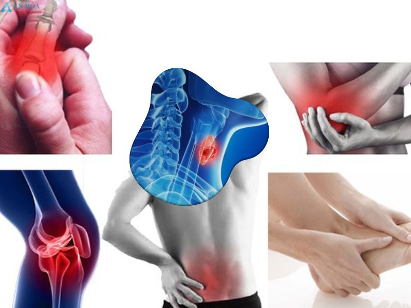 Hiện tượng u tuyến giáp