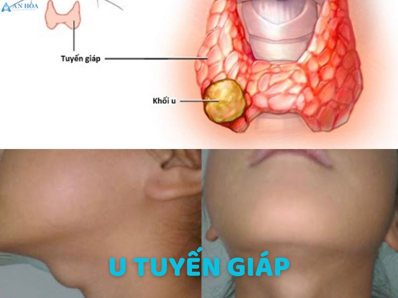 Hiện tượng u tuyến giáp