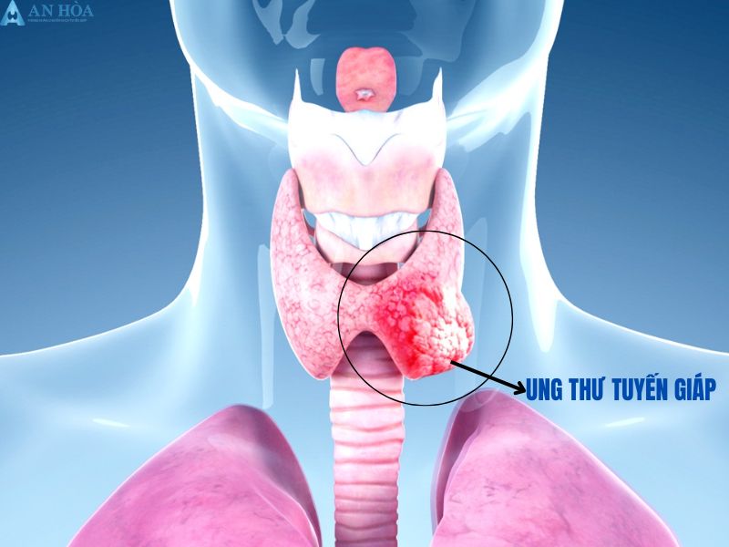 Nguyên nhân của bệnh bướu cổ