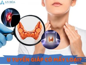 U tuyến giáp có mấy loại