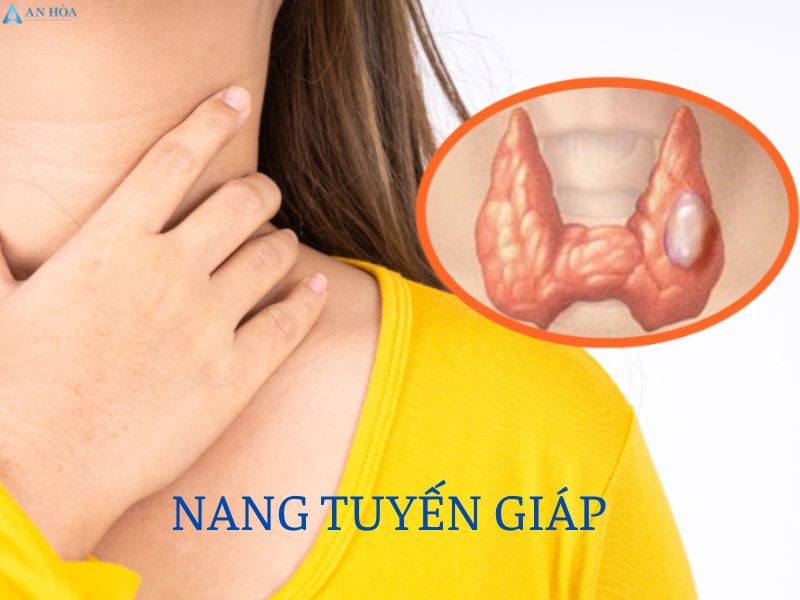 Bị nang tuyến giáp