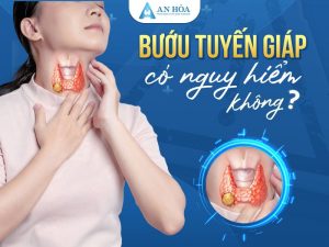 Bướu tuyến giáp có nguy hiểm không