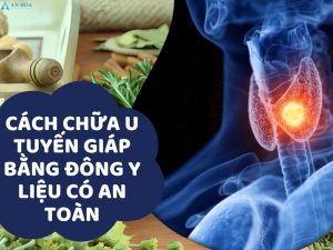 Cách chữa u tuyến giáp