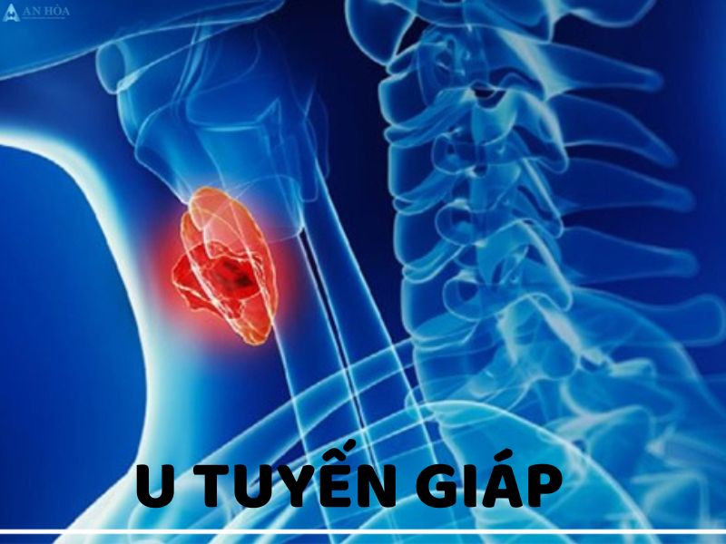 Đau tuyến giáp cổ