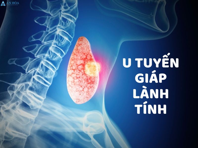 Điều trị u tuyến giáp lành tính