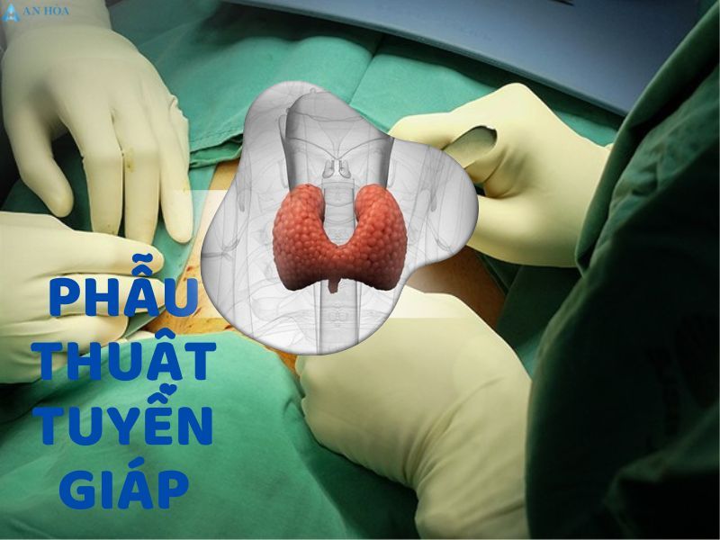 hội chứng cường giáp