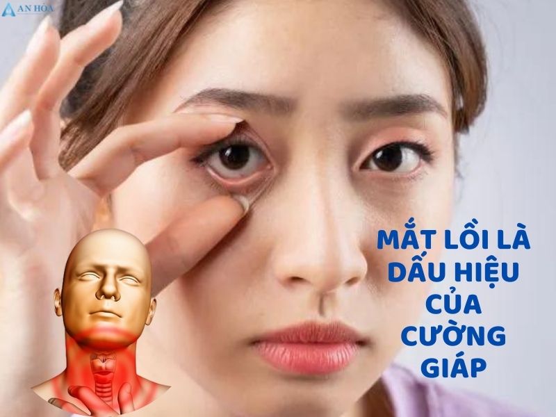 Hội chứng cường giáp