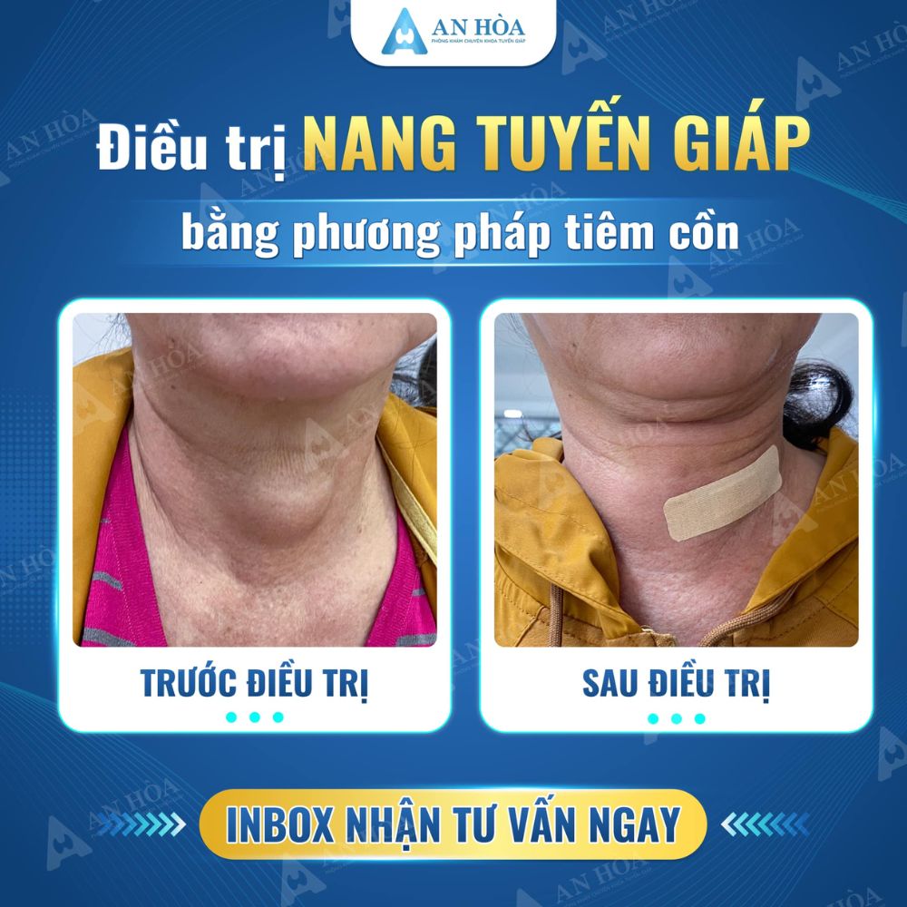 Kiểm tra tuyến giáp bằng cách nào