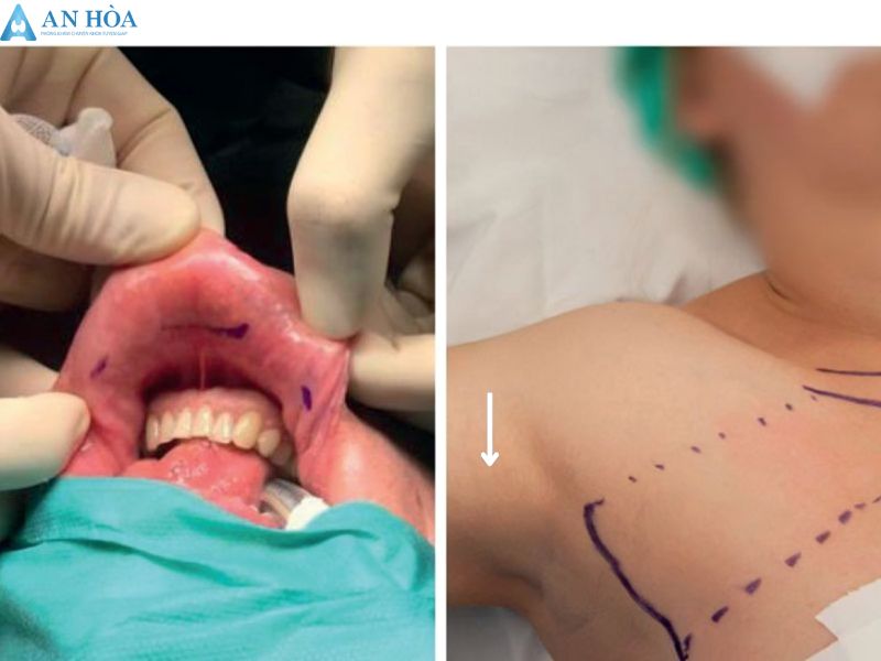 Mổ tuyến giáp có đau không