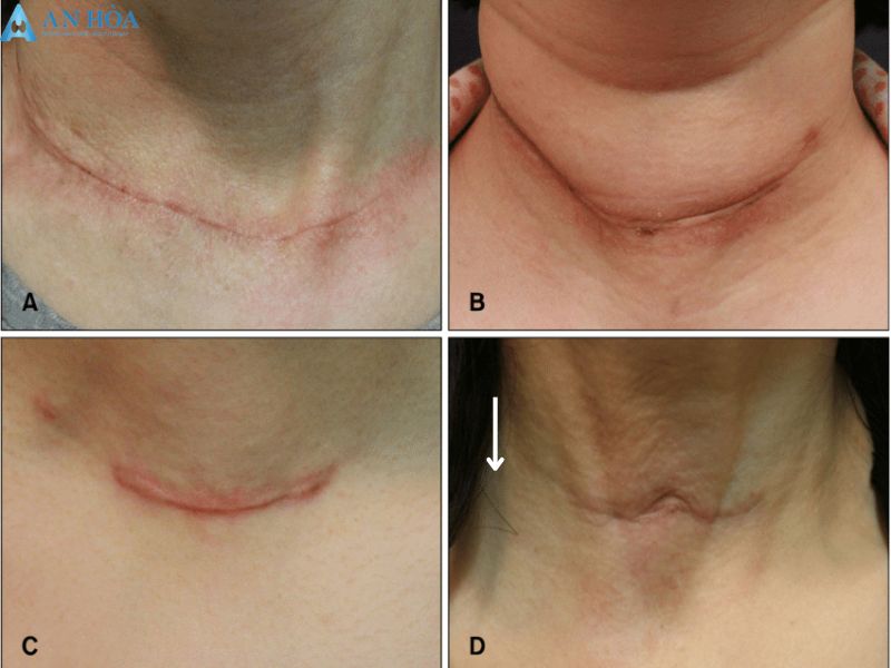Mổ tuyến giáp có đau không