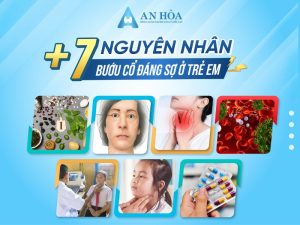 Nguyên nhân bướu cổ