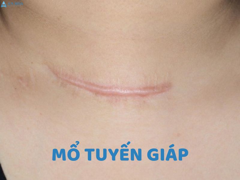Nguyên nhân gây cường giáp