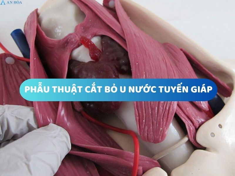 U nước tuyến giáp