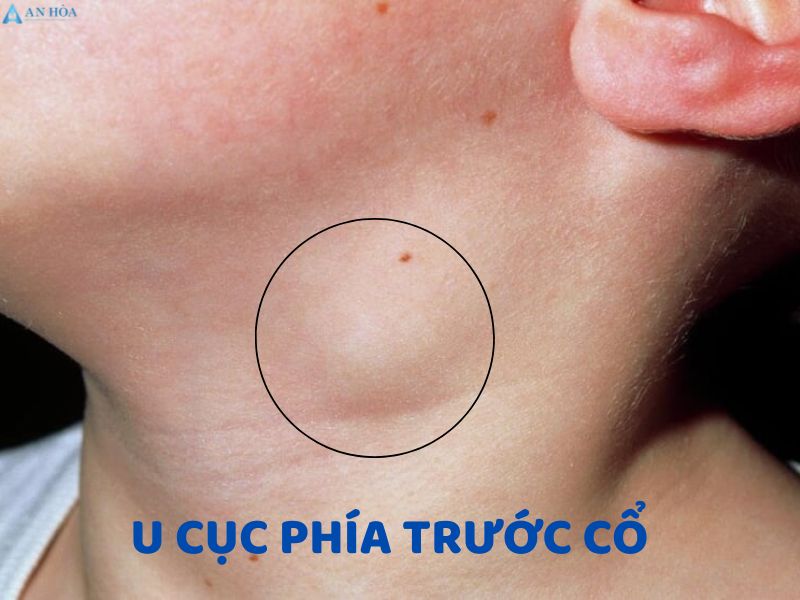 U nước tuyến giáp