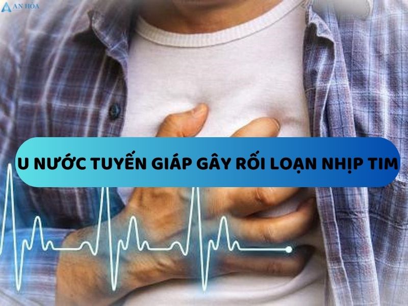 U nước tuyến giáp