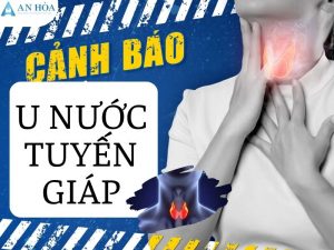 U nước tuyến giáp