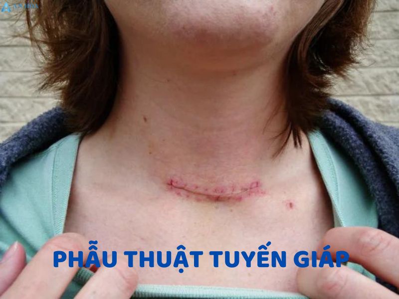 U tuyến giáp độ 4