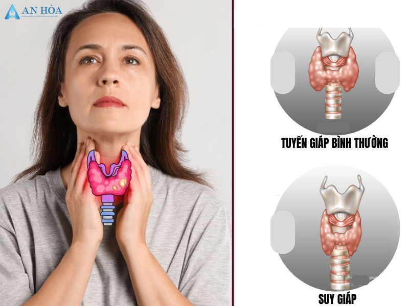 Bệnh suy giảm tuyến giáp