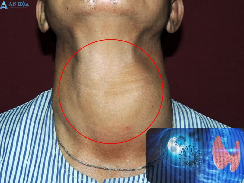 Bị đau tuyến giáp