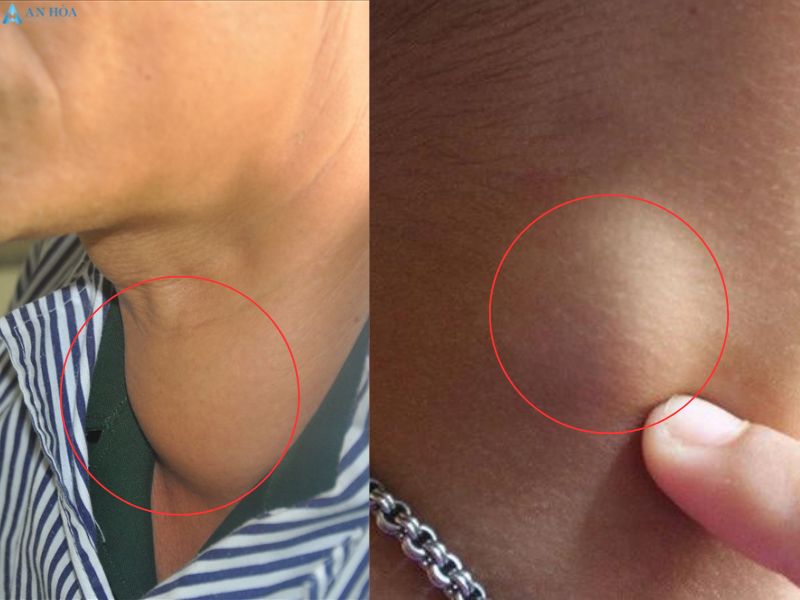Biểu hiện của tuyến giáp