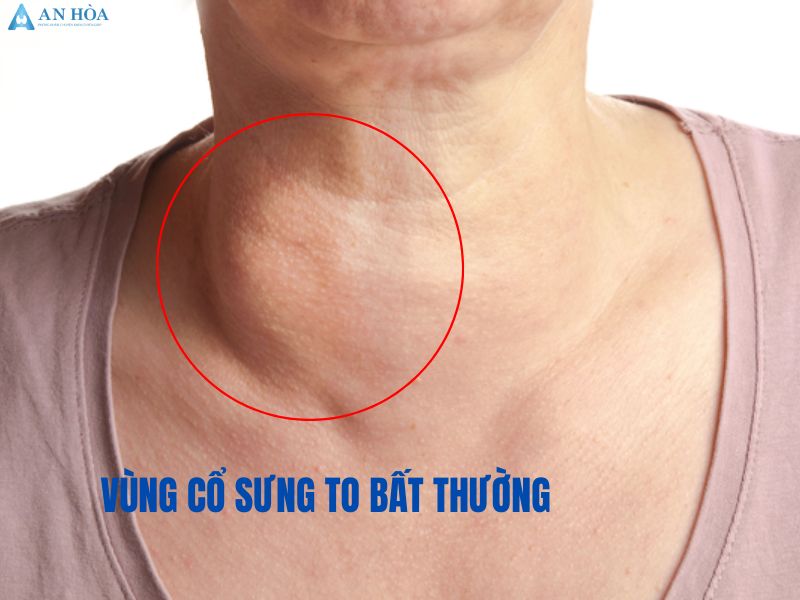 Biểu hiện rối loạn tuyến giáp