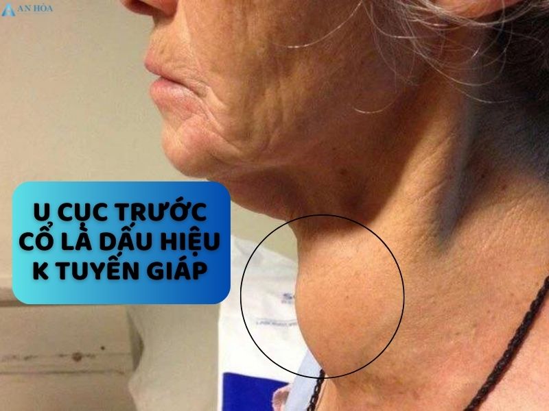 Dấu hiệu bị k tuyến giáp