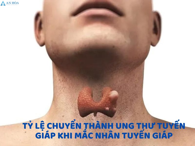 Nhân tuyến giáp thùy phải