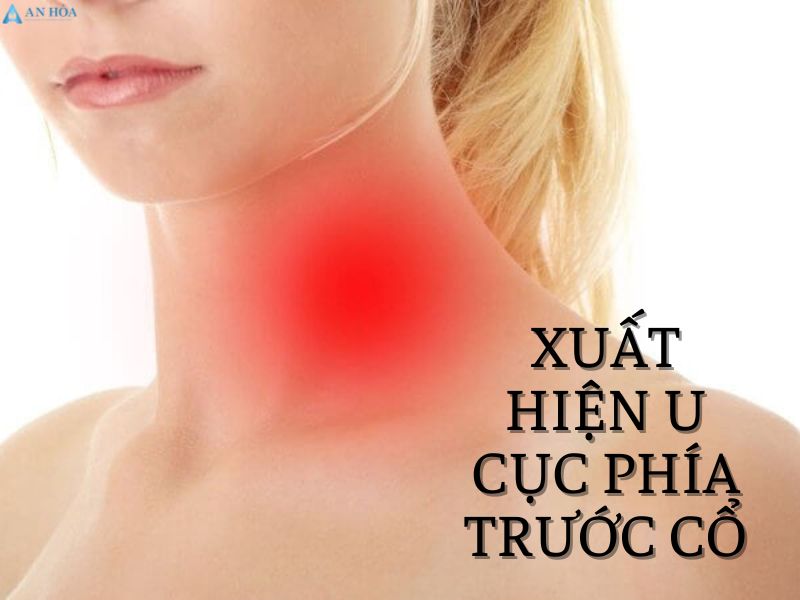 Nhân tuyến giáp thùy phải