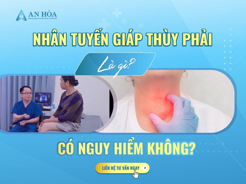 Nhân tuyến giáp thùy phải