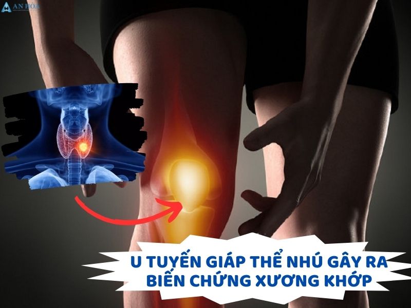 U tuyến giáp thể nhú