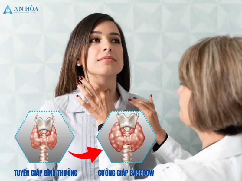 Biểu hiện của cường giáp