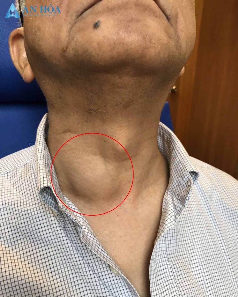 Biểu hiện ung thư tuyến giáp