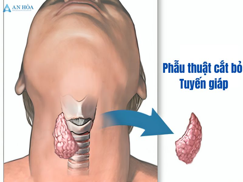 Nguyên nhân gây bệnh suy giáp