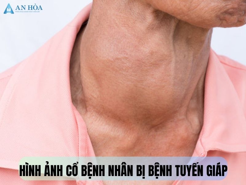 Nguyên nhân gây bệnh tuyến giáp