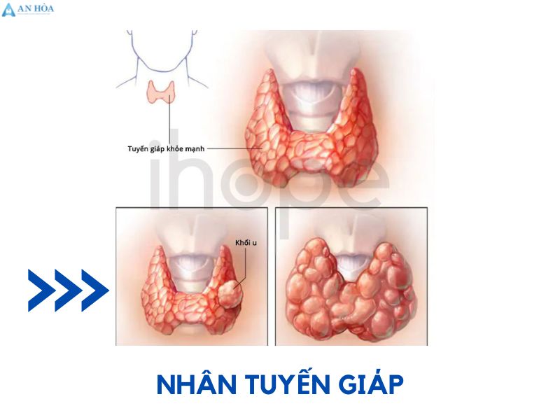 Nhân và nang tuyến giáp